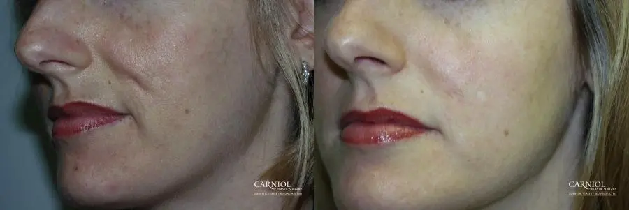 Acne Rejuvenation: Patient 2 - Before and After 1