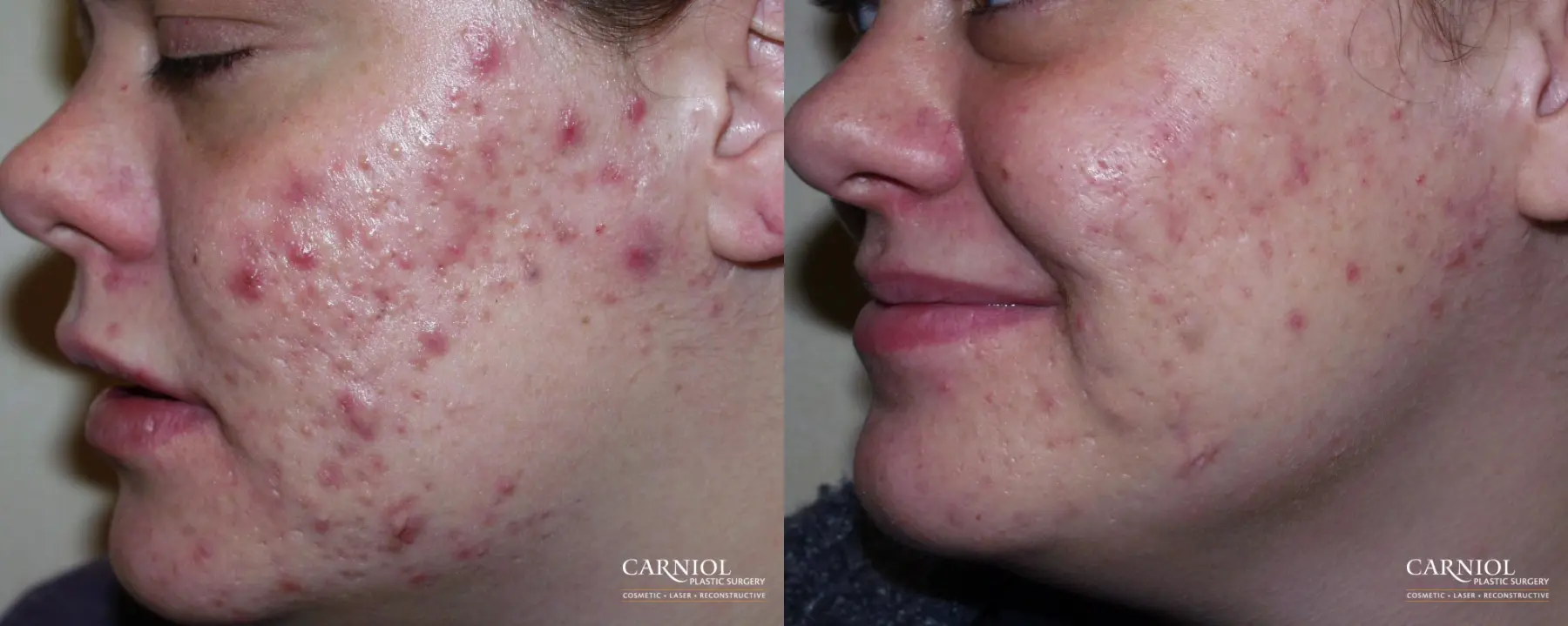 Acne Rejuvenation: Patient 1 - Before and After  