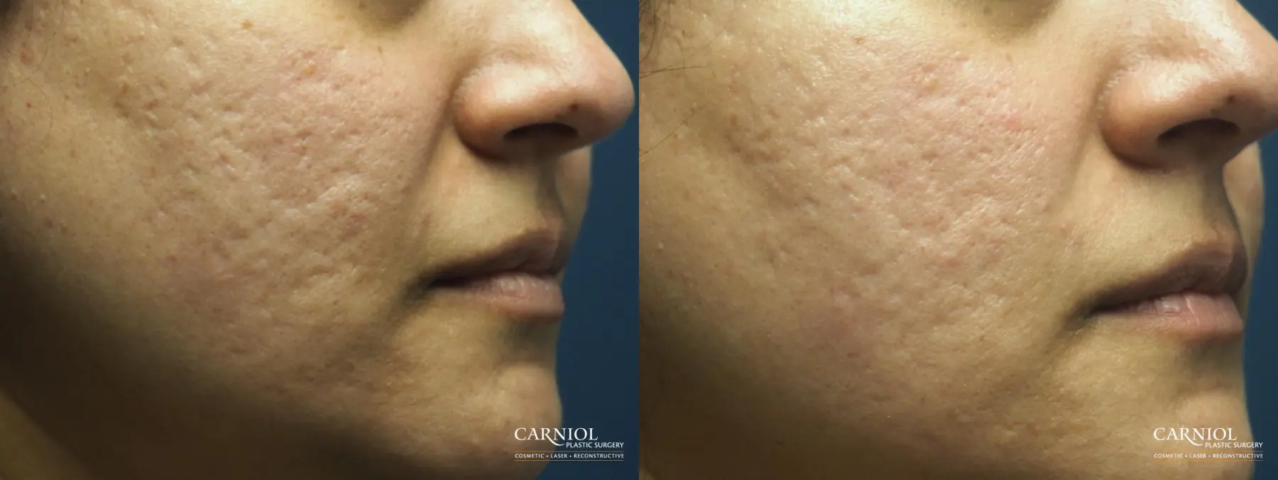 Acne Scars: Patient 4 - Before and After  