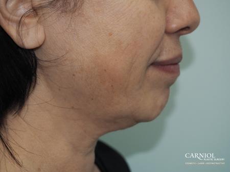 Non-Surgical Facelift: Patient 3 - Before Image 1