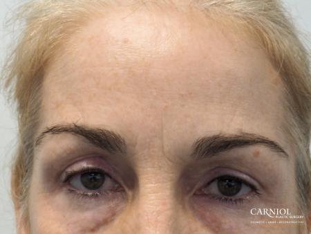 BOTOX® Cosmetic: Patient 5 - After Image