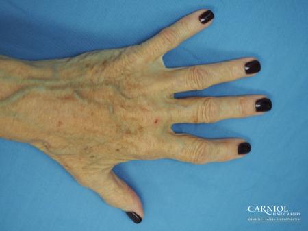 Radiesse Hand Rejuvenation - After Image 1