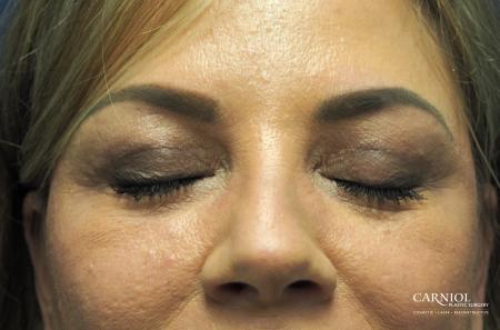 Blepharoplasty: Patient 2 - After Image 2