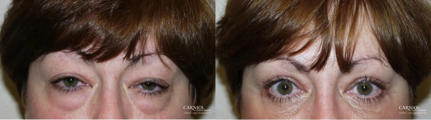 Eyelid Lift: Upper and Lower Blepharoplasty - Before and After  