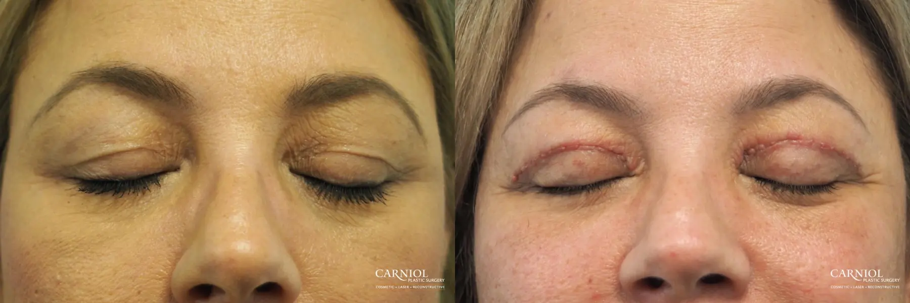 Blepharoplasty: Patient 5 - Before and After 2