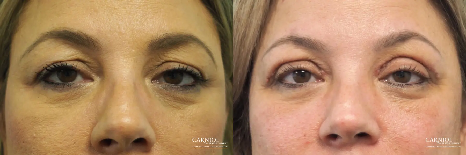 Blepharoplasty: Patient 5 - Before and After  