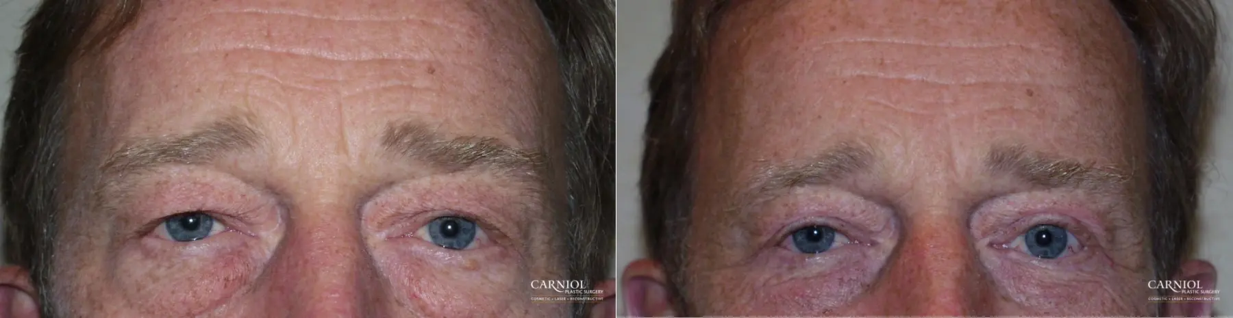 Blepharoplasty: Patient 3 - Before and After  