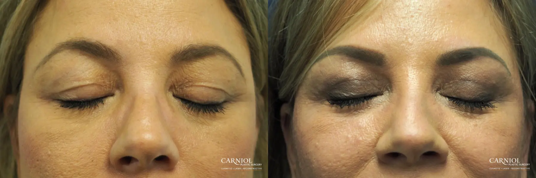 Blepharoplasty: Patient 6 - Before and After 2