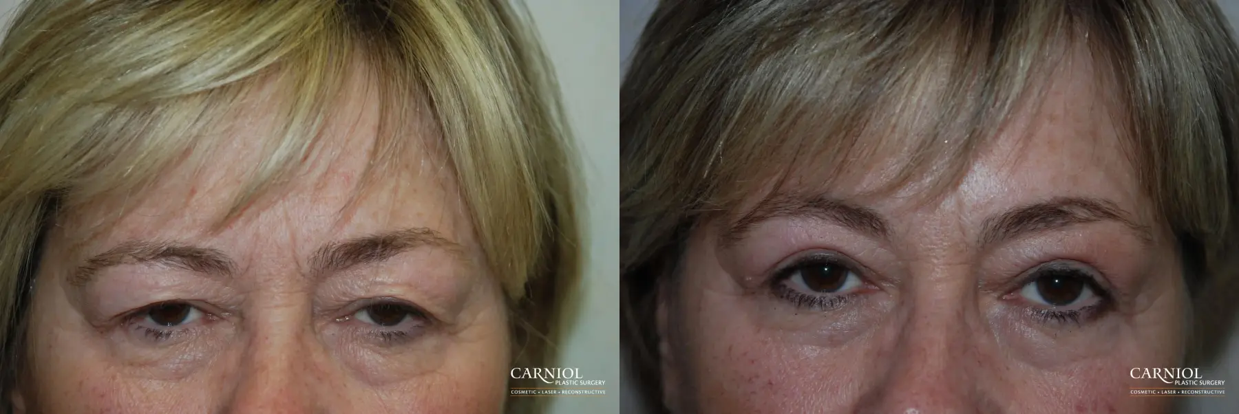 Upper Blepharoplasty Before - Before and After