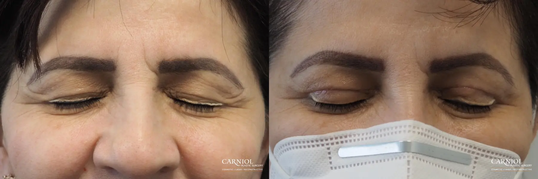 Blepharoplasty: Patient 7 - Before and After 2