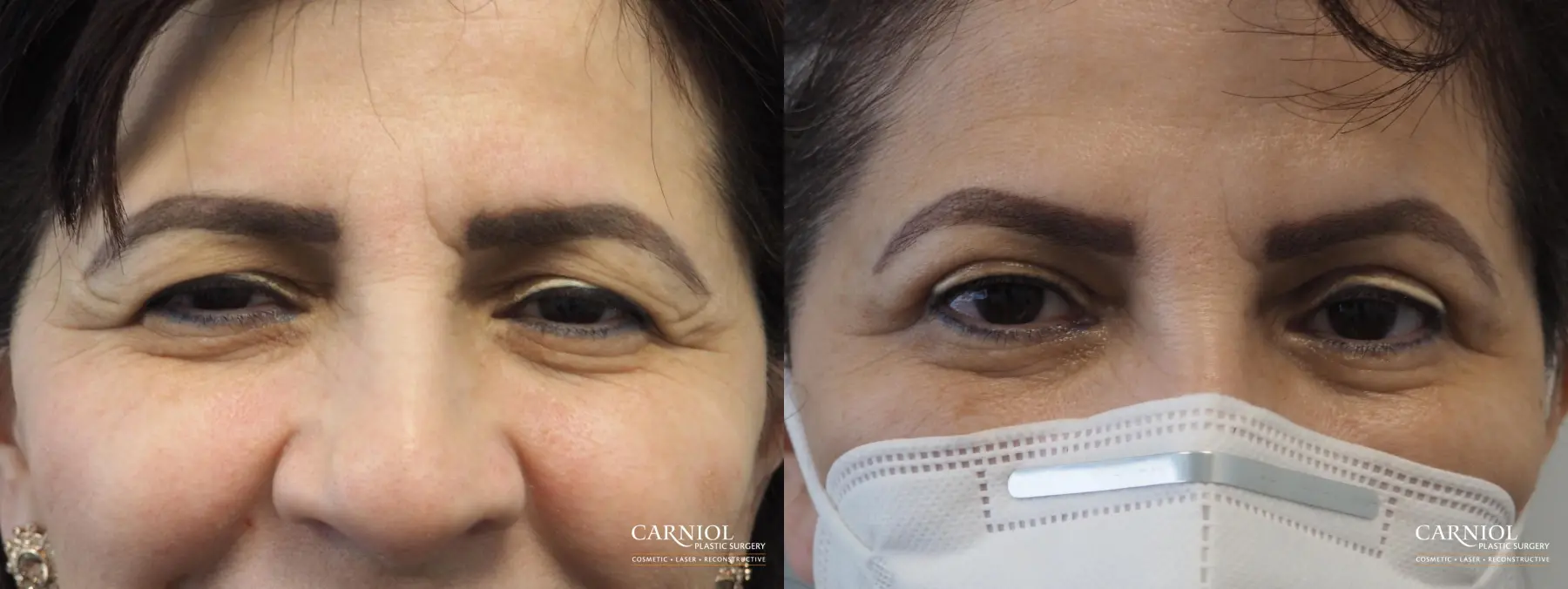 Blepharoplasty: Patient 7 - Before and After 1