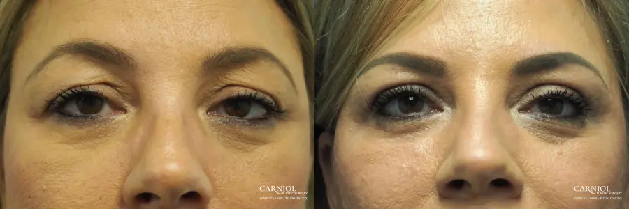 Blepharoplasty: Patient 6 - Before and After  