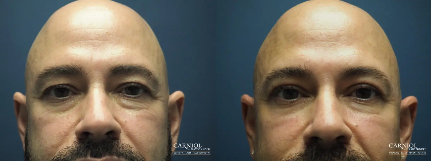 Blepharoplasty: Patient 8 - Before and After  