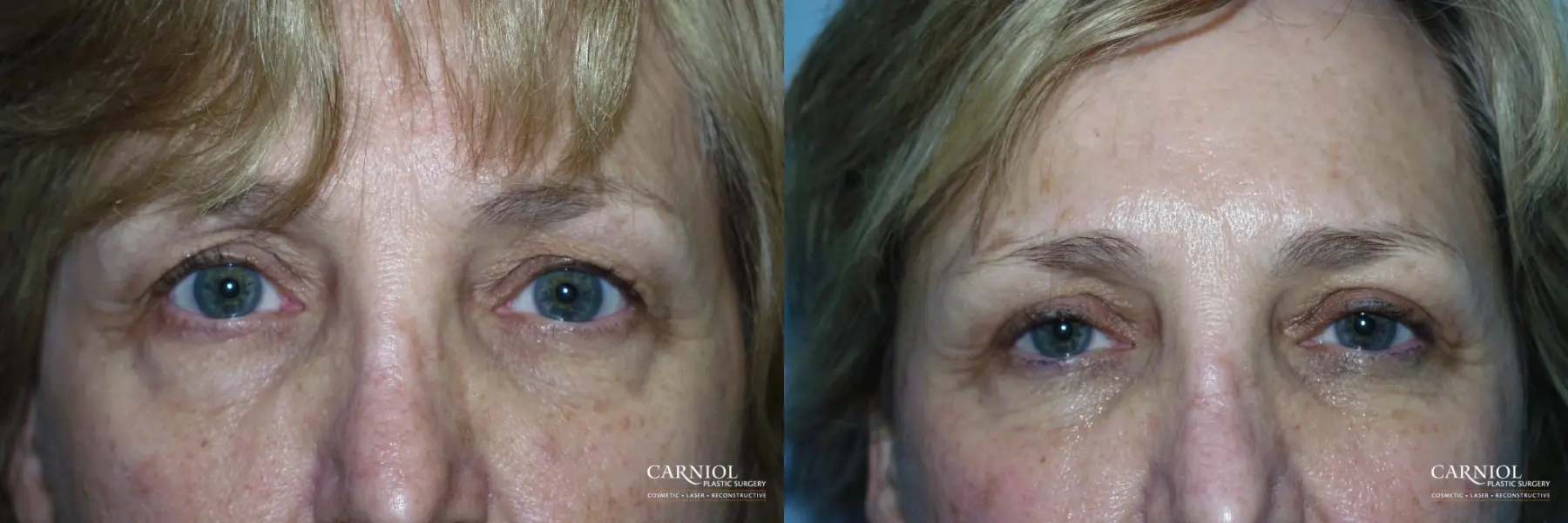 Blepharoplasty: Patient 4 - Before and After 1