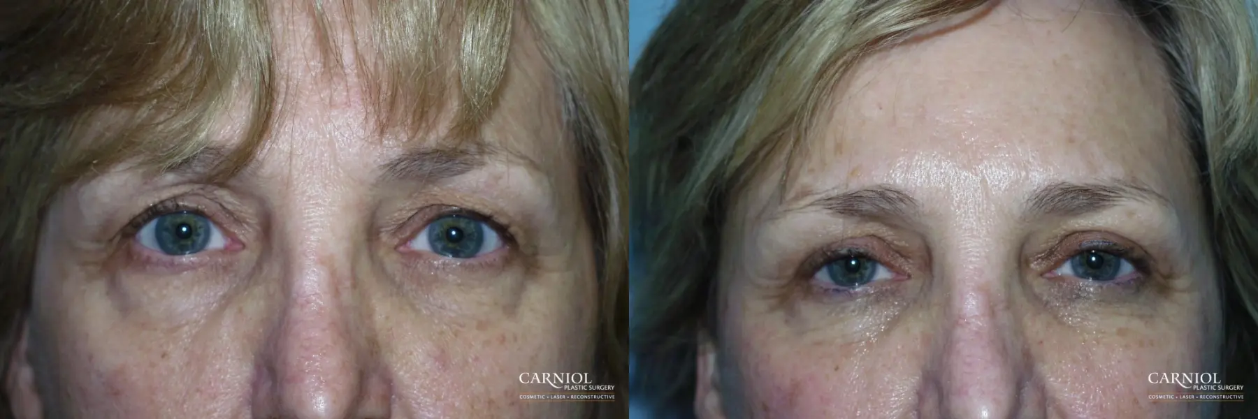 Blepharoplasty: Patient 4 - Before and After  