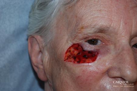 Skin Cancer Reconstruction - Face: Patient 5 - Before Image 1