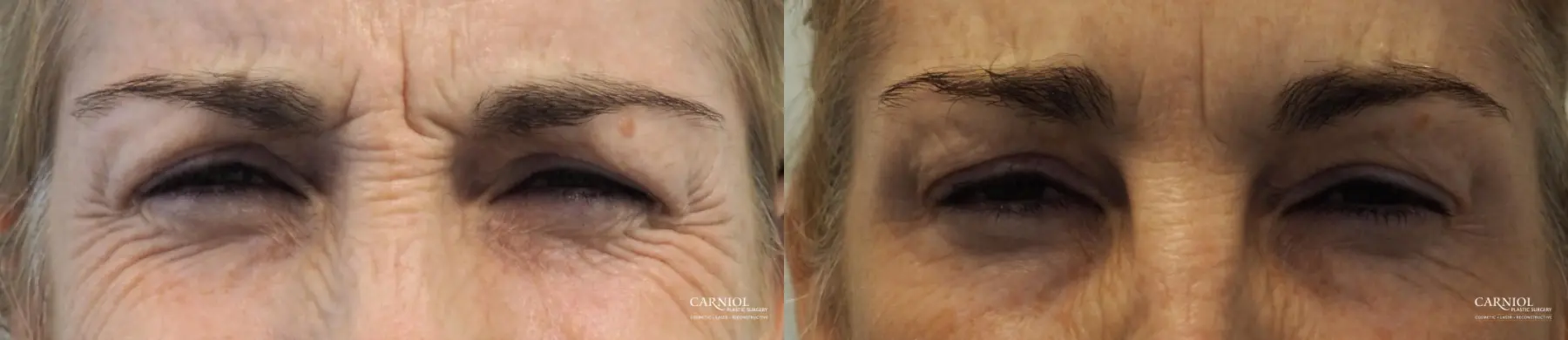 BOTOX® Cosmetic: Patient 5 - Before and After 3