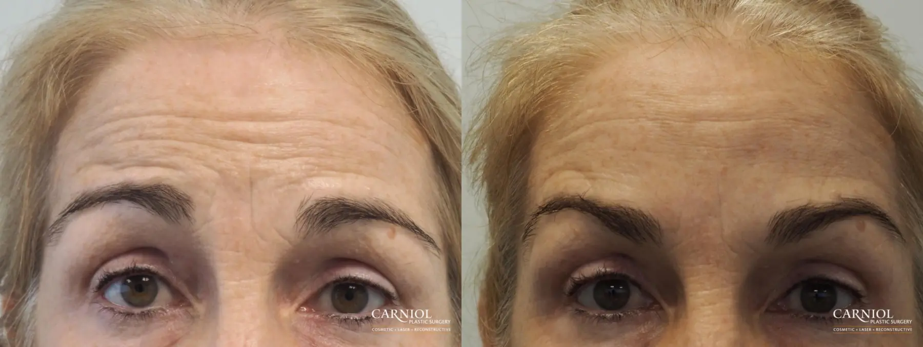 BOTOX® Cosmetic: Patient 5 - Before and After 2