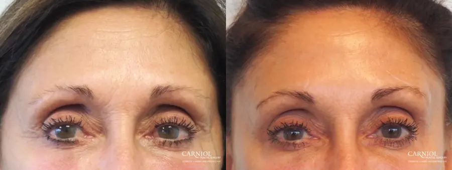 BOTOX® Cosmetic: Patient 6 - Before and After  