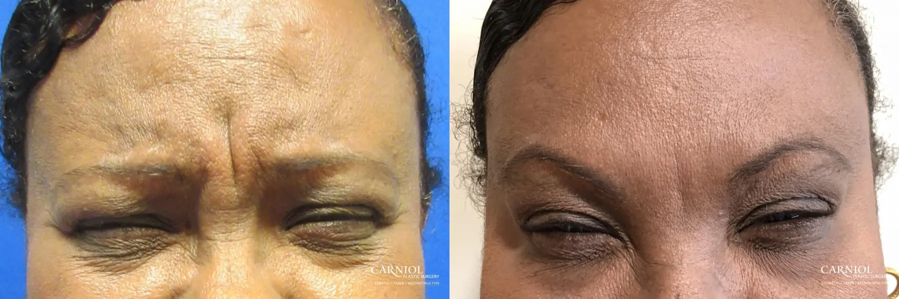 BOTOX® Cosmetic: Patient 3 - Before and After  