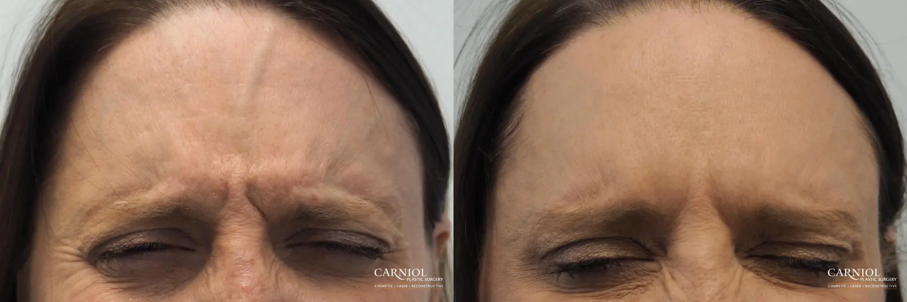 BOTOX® Cosmetic: Patient 4 - Before and After 3
