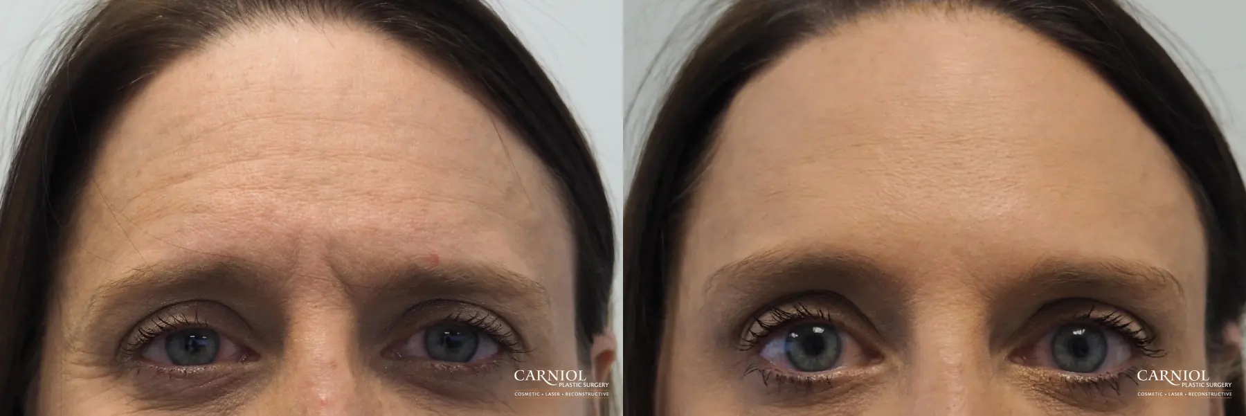 BOTOX® Cosmetic: Patient 4 - Before and After 1