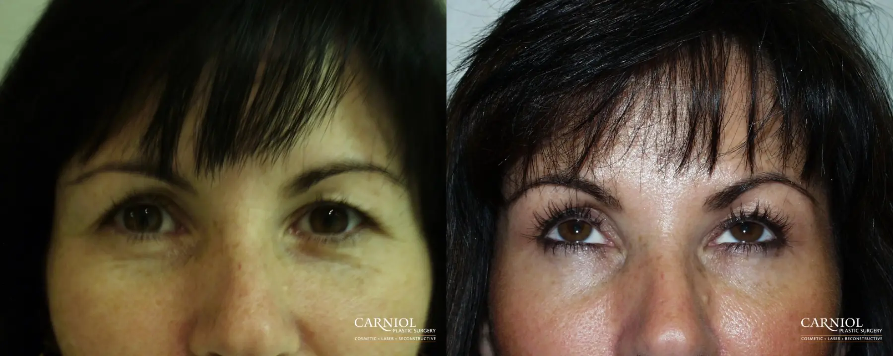 BOTOX® Cosmetic: Patient 2 - Before and After  