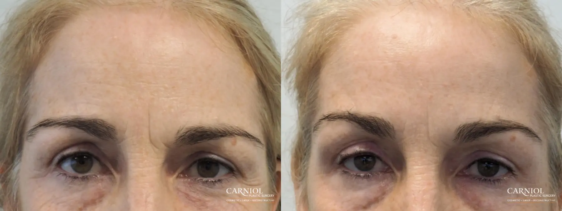BOTOX® Cosmetic: Patient 5 - Before and After 1