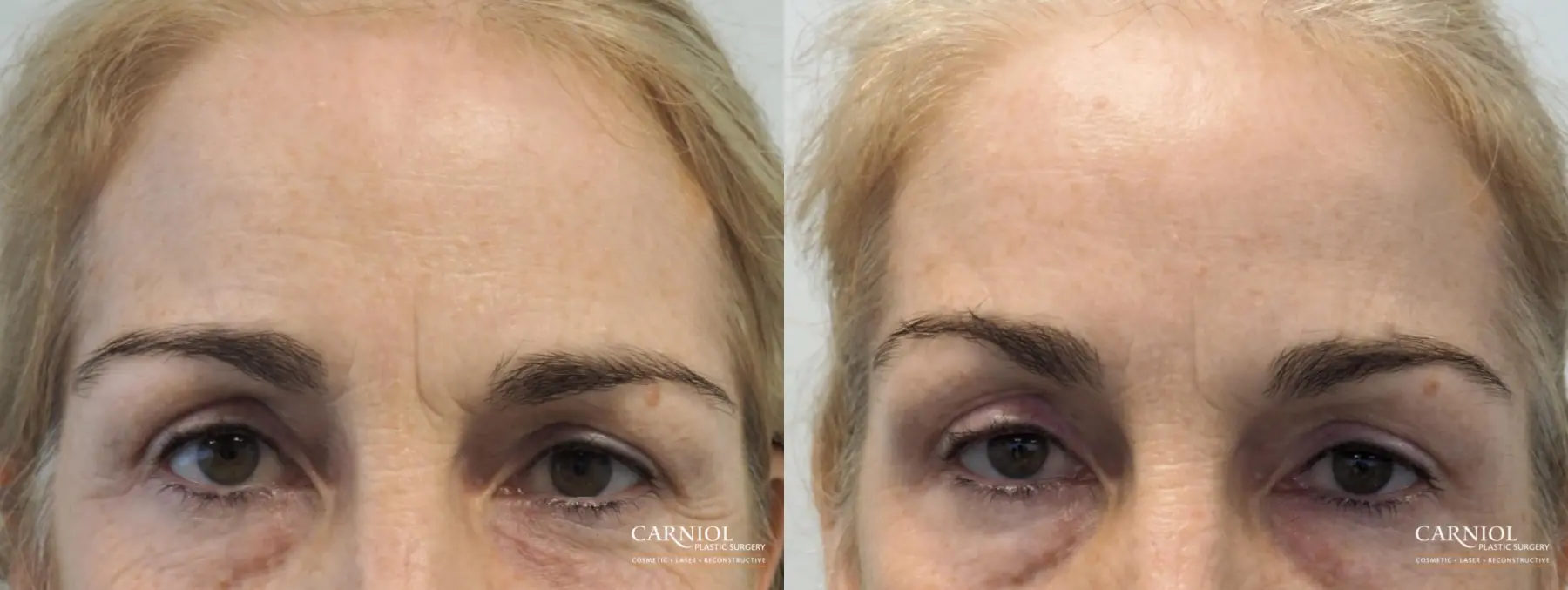 BOTOX® Cosmetic: Patient 5 - Before and After  