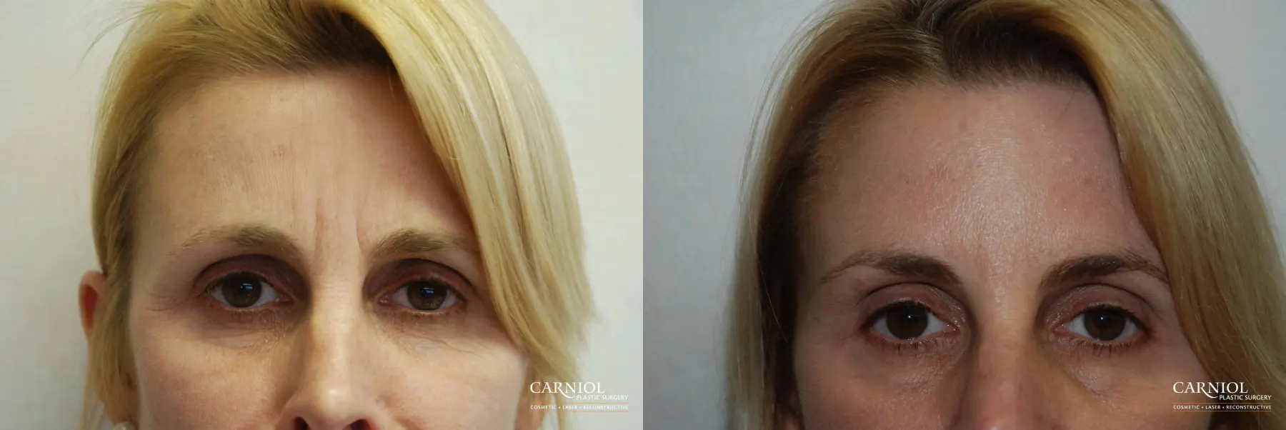 BOTOX® Cosmetic: Patient 1 - Before and After  