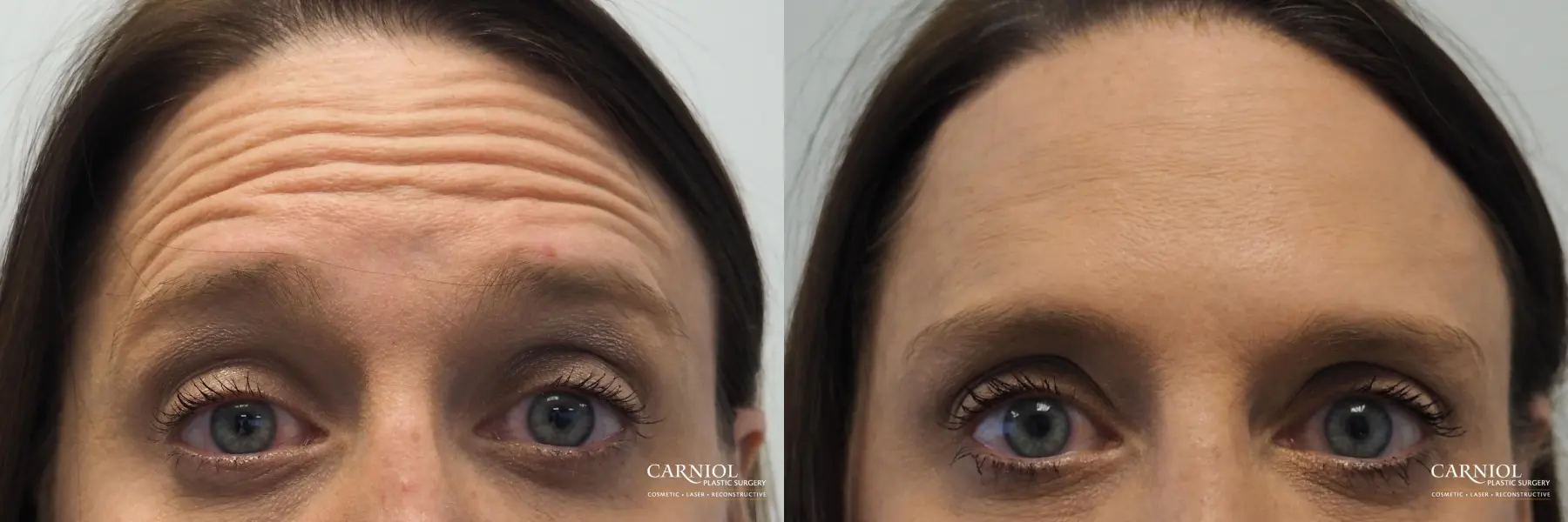 BOTOX® Cosmetic: Patient 4 - Before and After 2