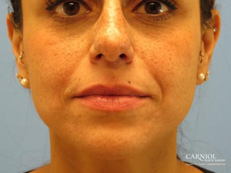 Scar Revision: Patient 3 - Before and After Image 4