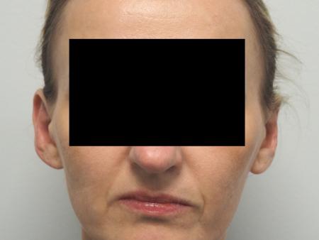 Otoplasty: Patient 3 - After Image 1
