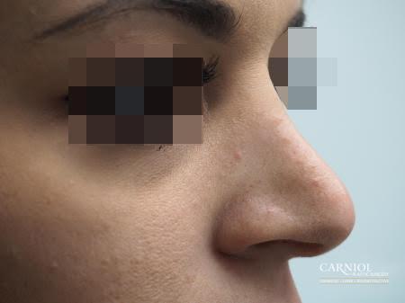 Non-Surgical Rhinoplasty: Patient 1 - Before Image 1