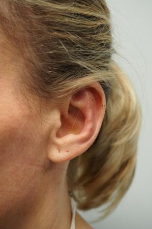 Otoplasty: Patient 3 - After Image 4