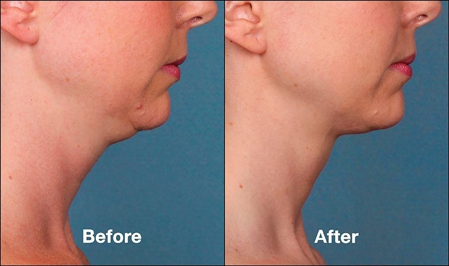 Double Chin, Kybella: Patient 2 - Before and After  