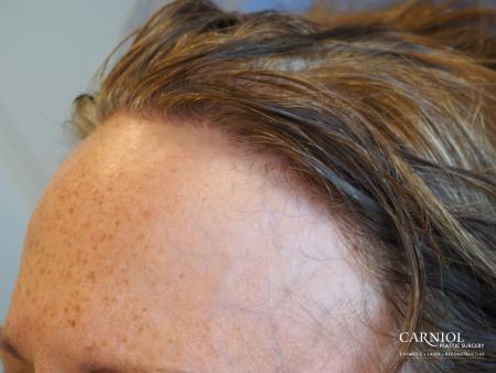 Nonsurgical Hair Restoration: Patient 1 - Before and After Image 3