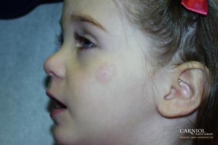 Hemangioma: Patient 1 - After Image 1