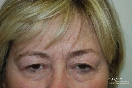 Upper Blepharoplasty Before - Before Image 1