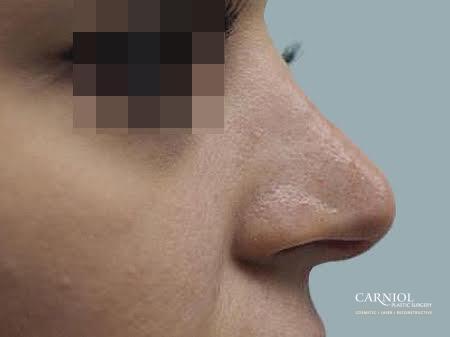 Non-Surgical Rhinoplasty: Patient 1 - After Image 1