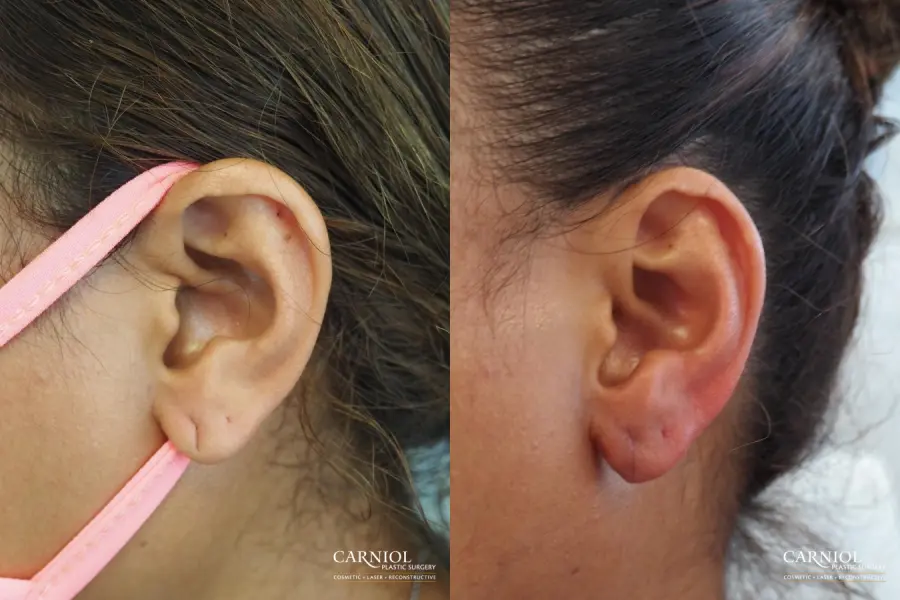 Earlobe Surgery: Patient 1 - Before and After  