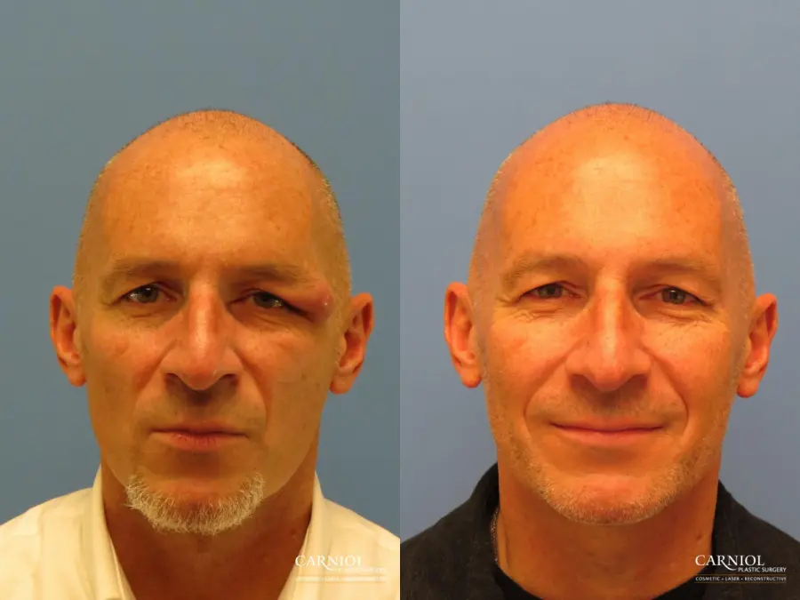 Eyelid Surgery: Patient 1 - Before and After  