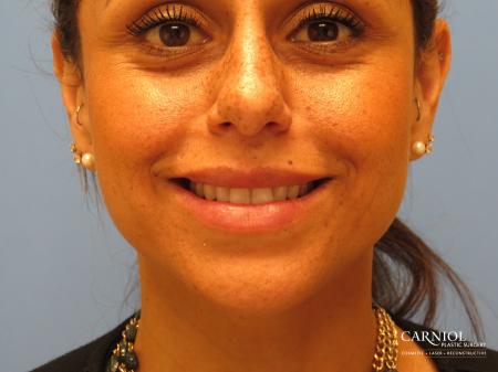 Scar Revision: Patient 3 - After Image 4