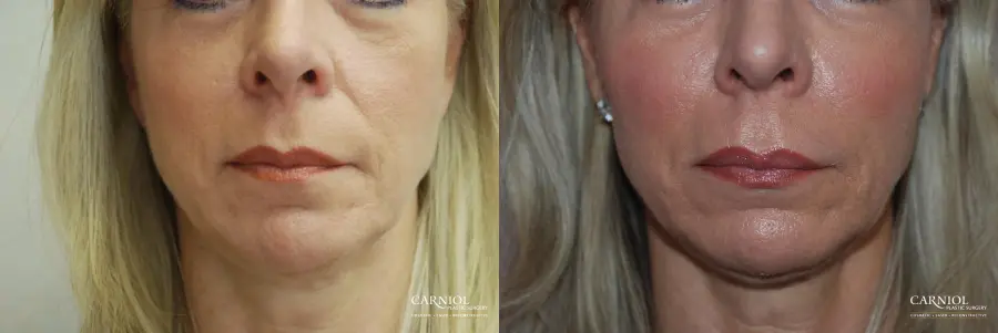 Facial Tightening: Patient 7 - Before and After 1