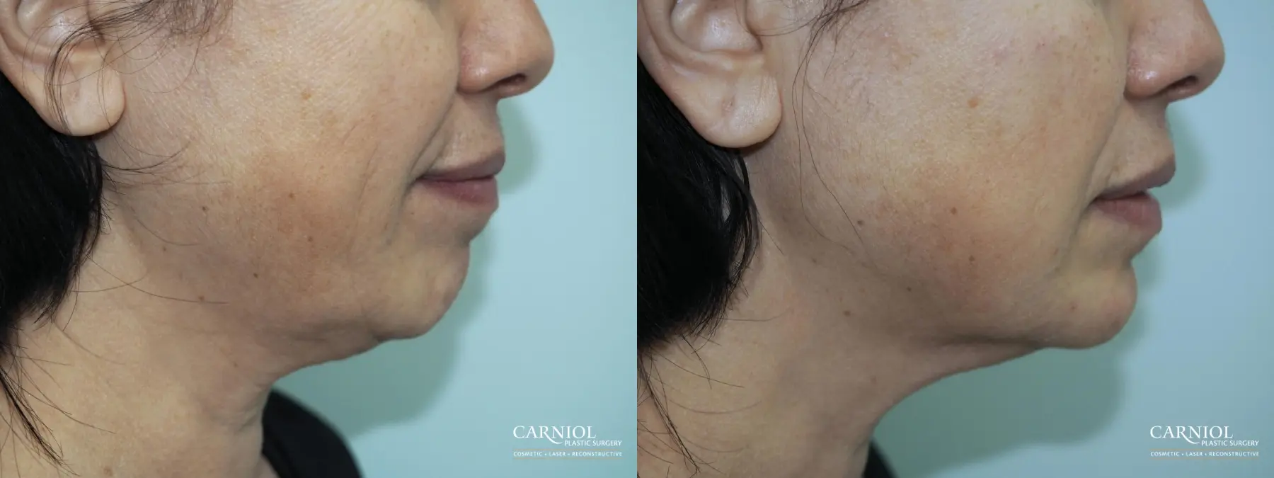 Facial Tightening: Patient 1 - Before and After  