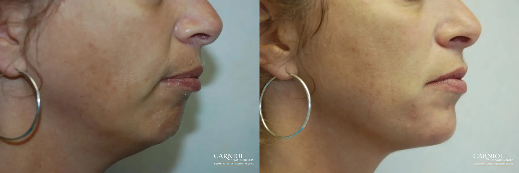 Facial Tightening: Patient 3 - Before and After  