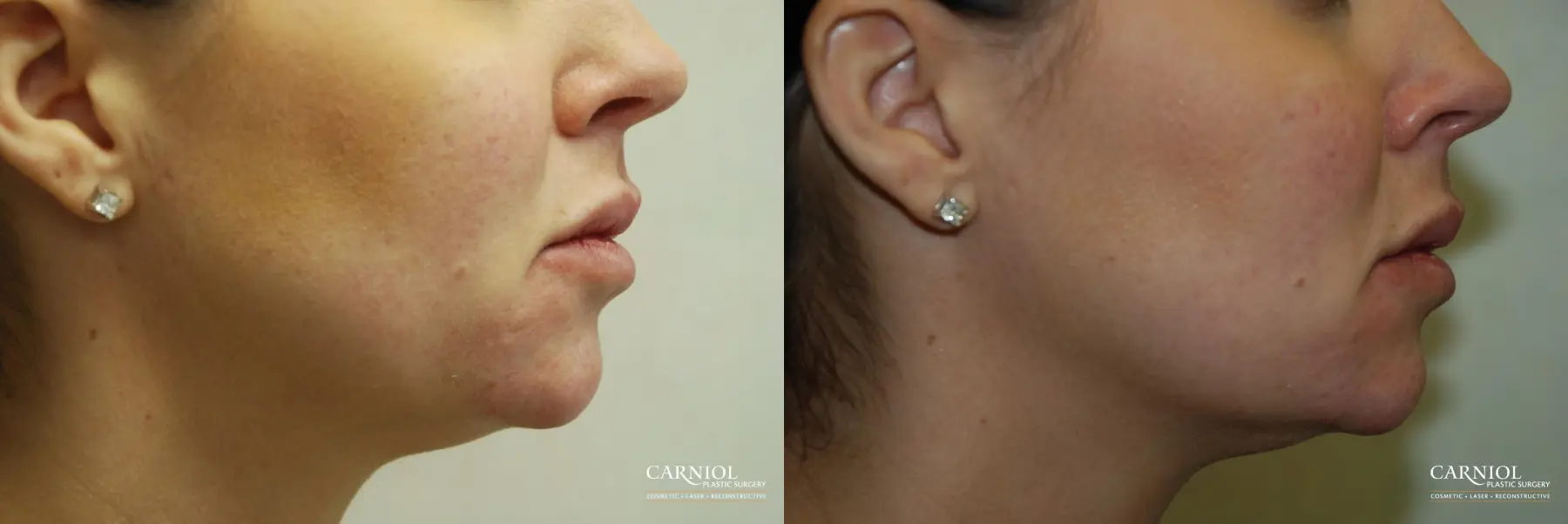 Facial Tightening: Patient 4 - Before and After  