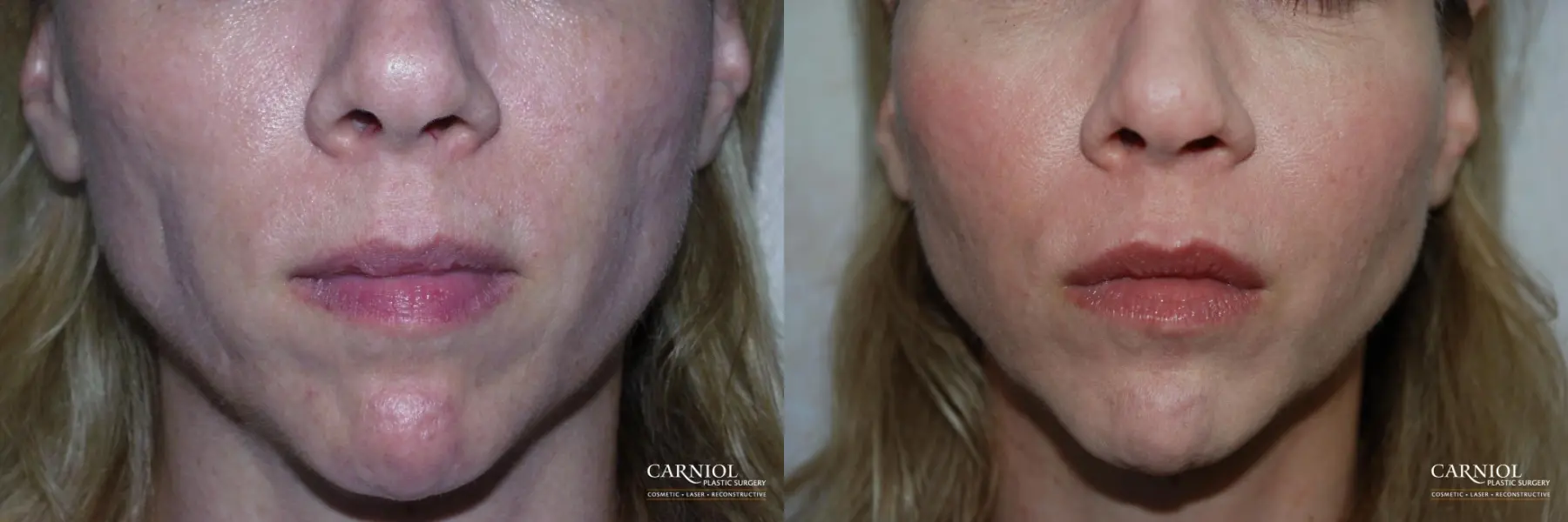 Facial Tightening: Patient 8 - Before and After  