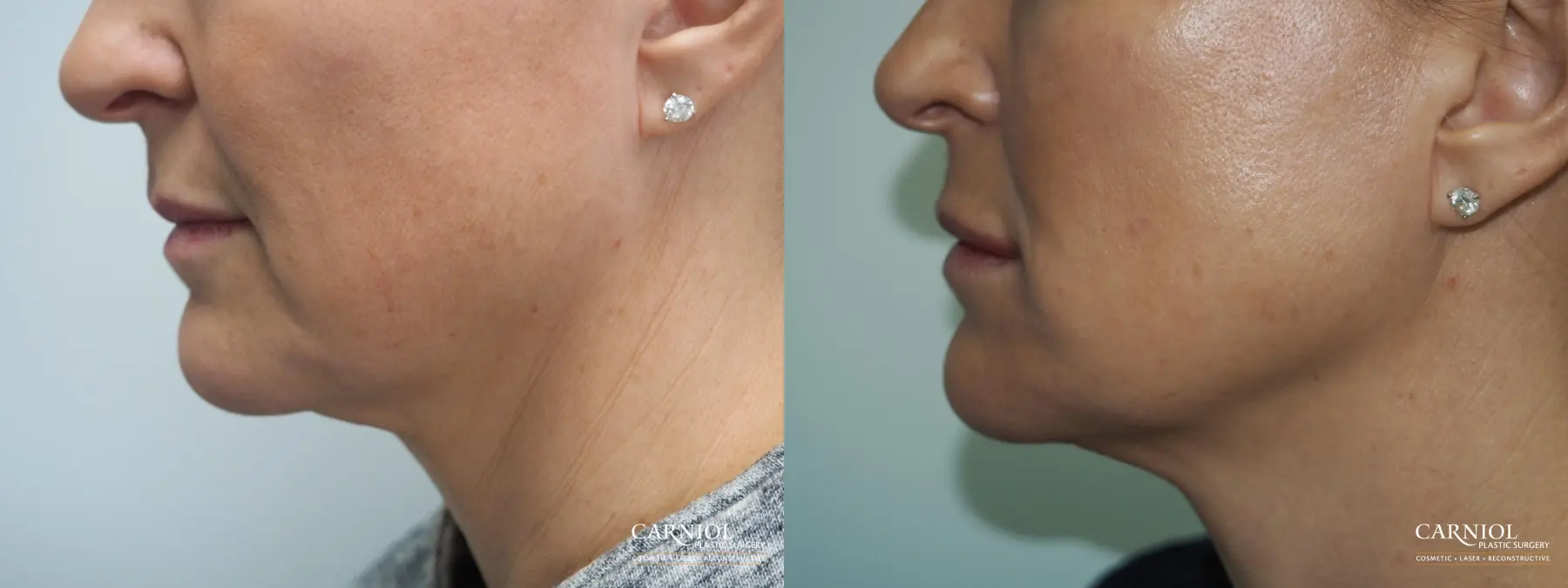 Facial Tightening: Patient 2 - Before and After  