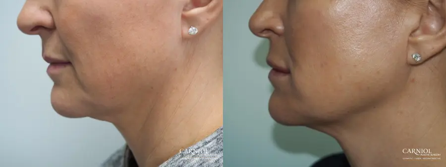 Facial Tightening: Patient 2 - Before and After 1